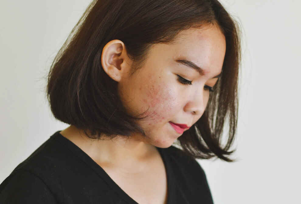 A Guide To Understanding Acne
